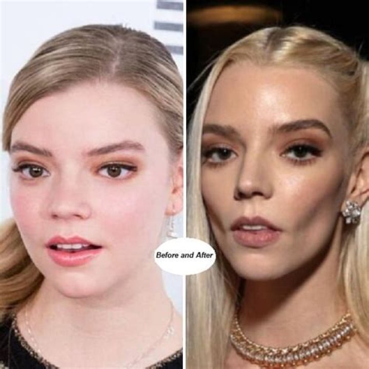 Anya Taylor Joy Before and After Enhancements: Fillers, Uplifts, or Fat Removal Surgery?