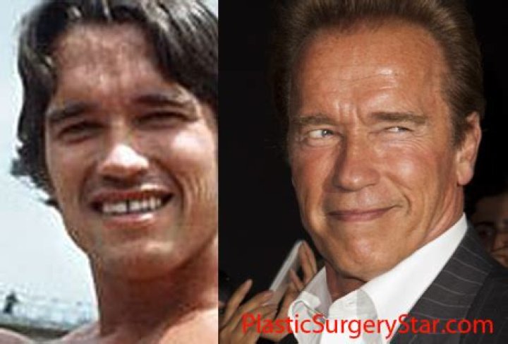 Arnold Schwarzenegger Plastic Surgery Before and After