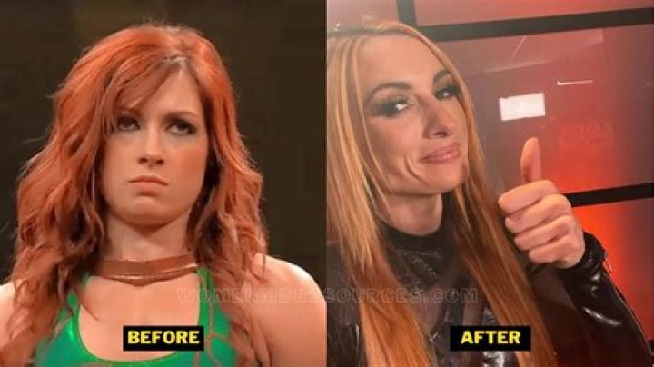 Becky Lynch Plastic Surgery: The Truth Behind Her Stunning ESPY Appearance