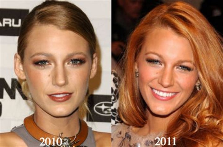 Blake Lively Breast Implants & Nose Job Plastic Surgery – Before and After