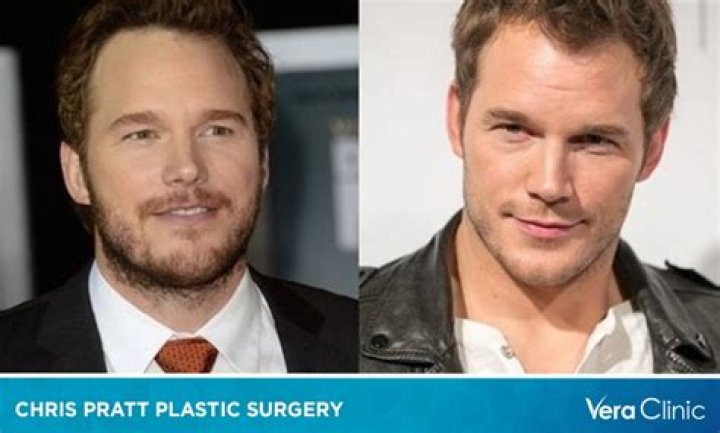 Chris Pratt Plastic Surgery Before and After