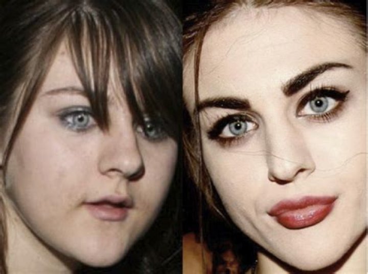Frances Bean Cobain Plastic Surgery Before and After